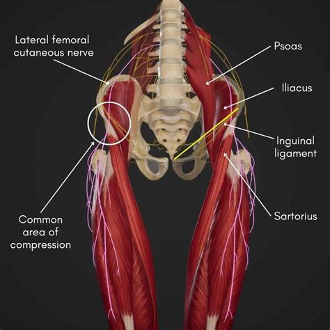 meralgia paresthetica of right side